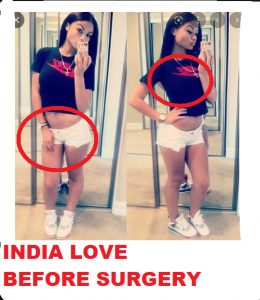 India Love BBL! India Love Before Surgery!! - FameLord