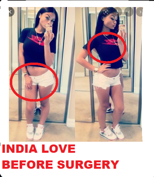 INDIA LOVE BEFORE SURGERY