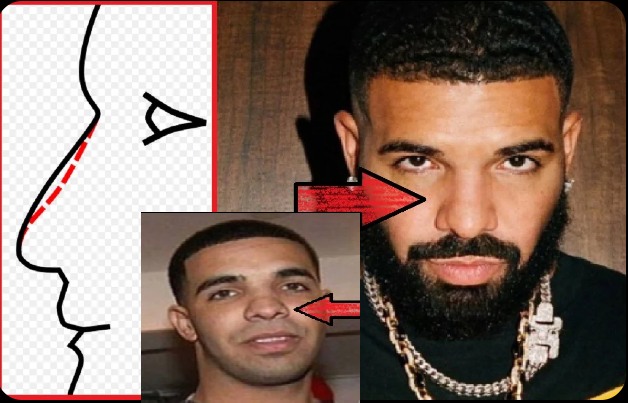 Is Drake Nose Job Rhinoplasty Surgery True? - FameLord