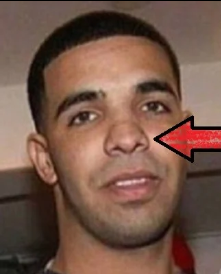 Is Drake Nose Job Rhinoplasty Surgery True? - FameLord