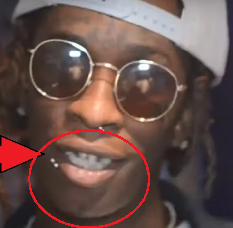 young thug teeth