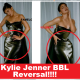 Kylie Jenner BBL Reversal