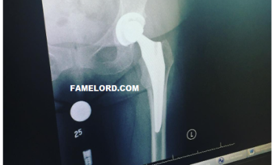 What I Wish I Knew Before Hip Replacement Surgery